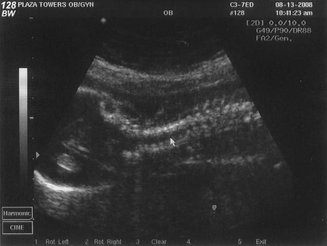 spine-21w5d