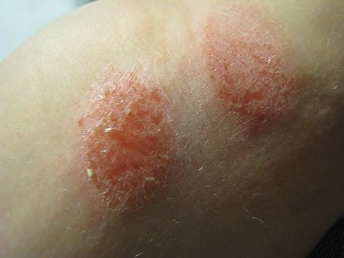 Skin eczema is one of the most common skin diseases around today.
