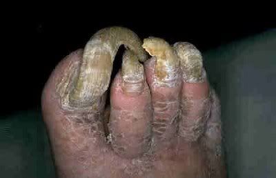 ugly feet